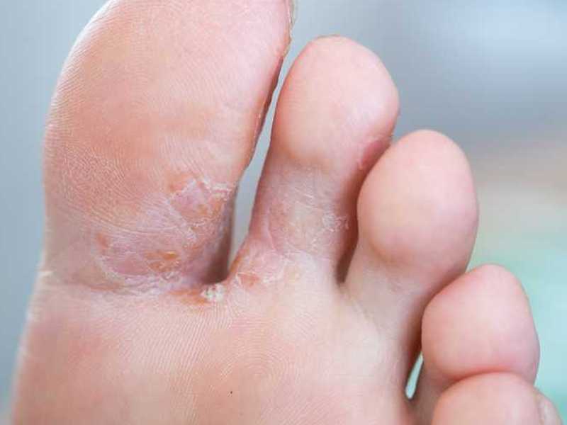  foot fungus healing methods